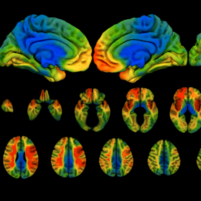 A lesion overlap map of the Iowa Neurological Patient Registry
