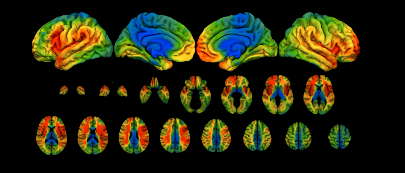 A lesion overlap map of the Iowa Neurological Patient Registry