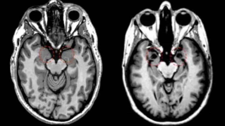 S.M. Amydala Comparison